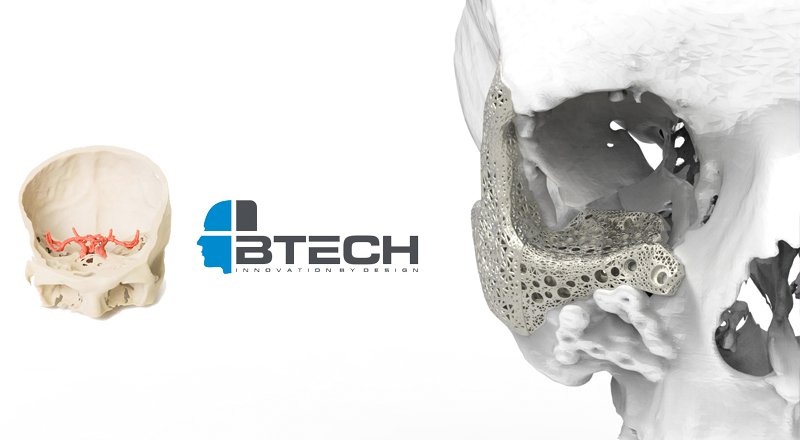 Btech Innovation, medikal 3 boyutlu üretim konusunda öncü rol üstleniyor