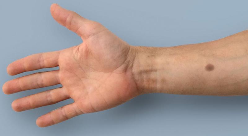 Yapay ben ile dört kanser türünde erken teşhis sağlanabilir