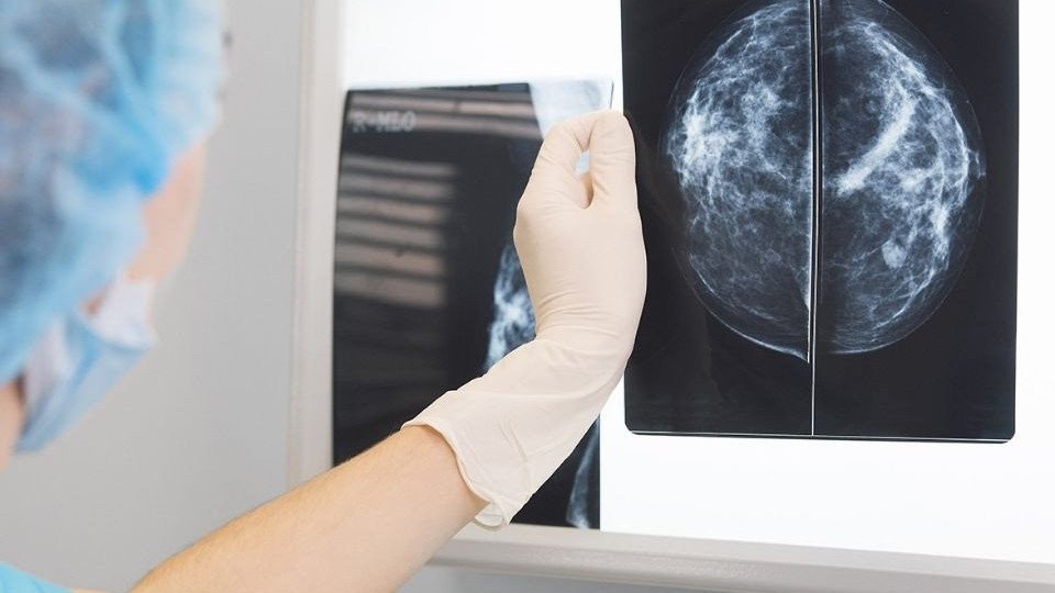 MIT'nin geliştirdiği yapay zeka aracı, meme kanserinin gelişimini 5 yıl öncesine kadar tespit edebiliyor